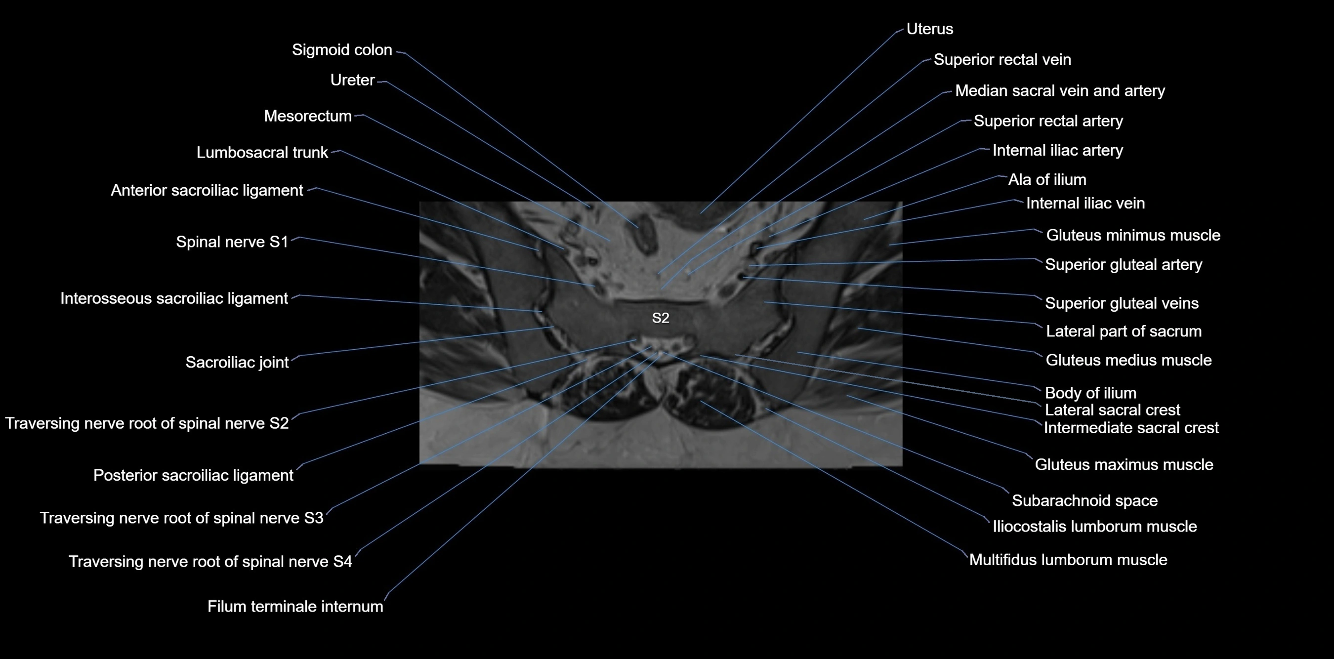 MRI sacrum, coccyx and sacroiliac joint axial cross sectional anatomy 3T  radiology  image-img-00001-00025.webp